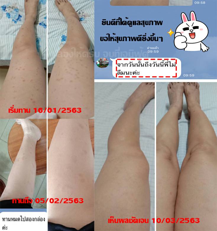 ความรู้สึกจากใจผู้ใช้จริง ผู้เป็นโรคสะเก็ดเงิน 1