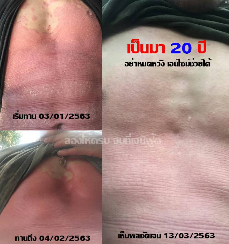 ความรู้สึกจากใจผู้ใช้จริง ผู้เป็นโรคสะเก็ดเงิน 1