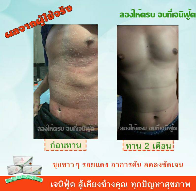 ความรู้สึกจากใจผู้ใช้จริง ผู้เป็นโรคสะเก็ดเงิน 2