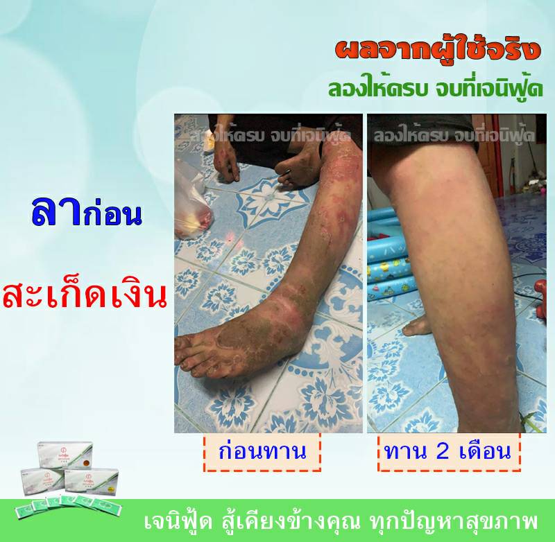 ความรู้สึกจากใจผู้ใช้จริง ผู้เป็นโรคสะเก็ดเงิน 3